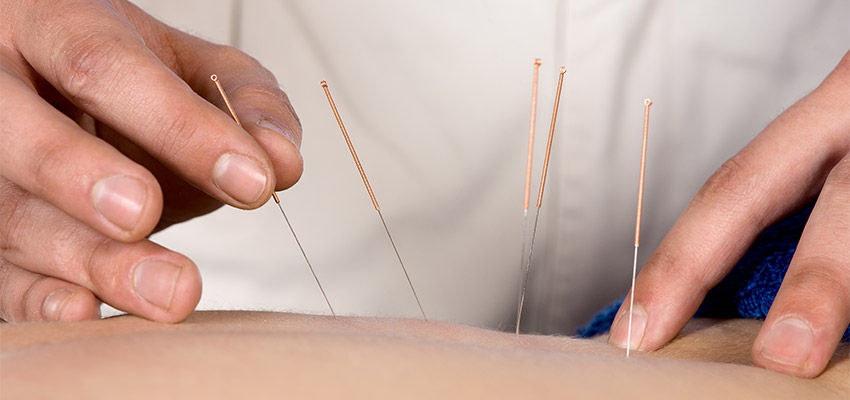 acupuncture treatment